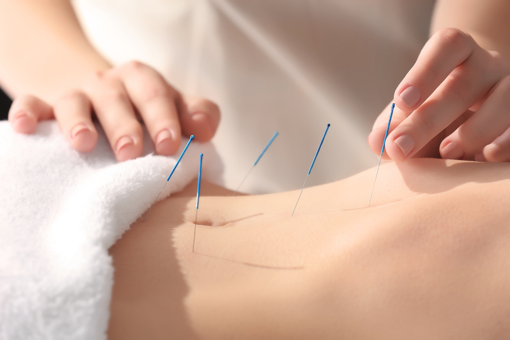 Pratique de l'acupuncture en fin de grossesse pour déclencher l'accouchement